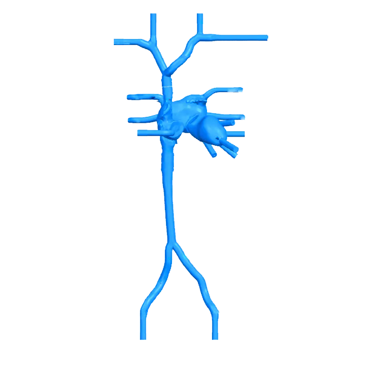 Drawing of Transseptal Puncture Vessel Model - Type B