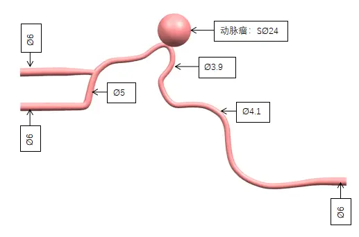 Drawing of Aneurysm Model