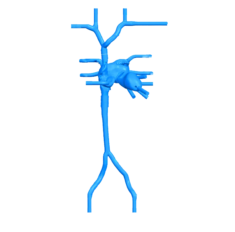 Main Dimensions of Transseptal Puncture Vessel Model - Type B