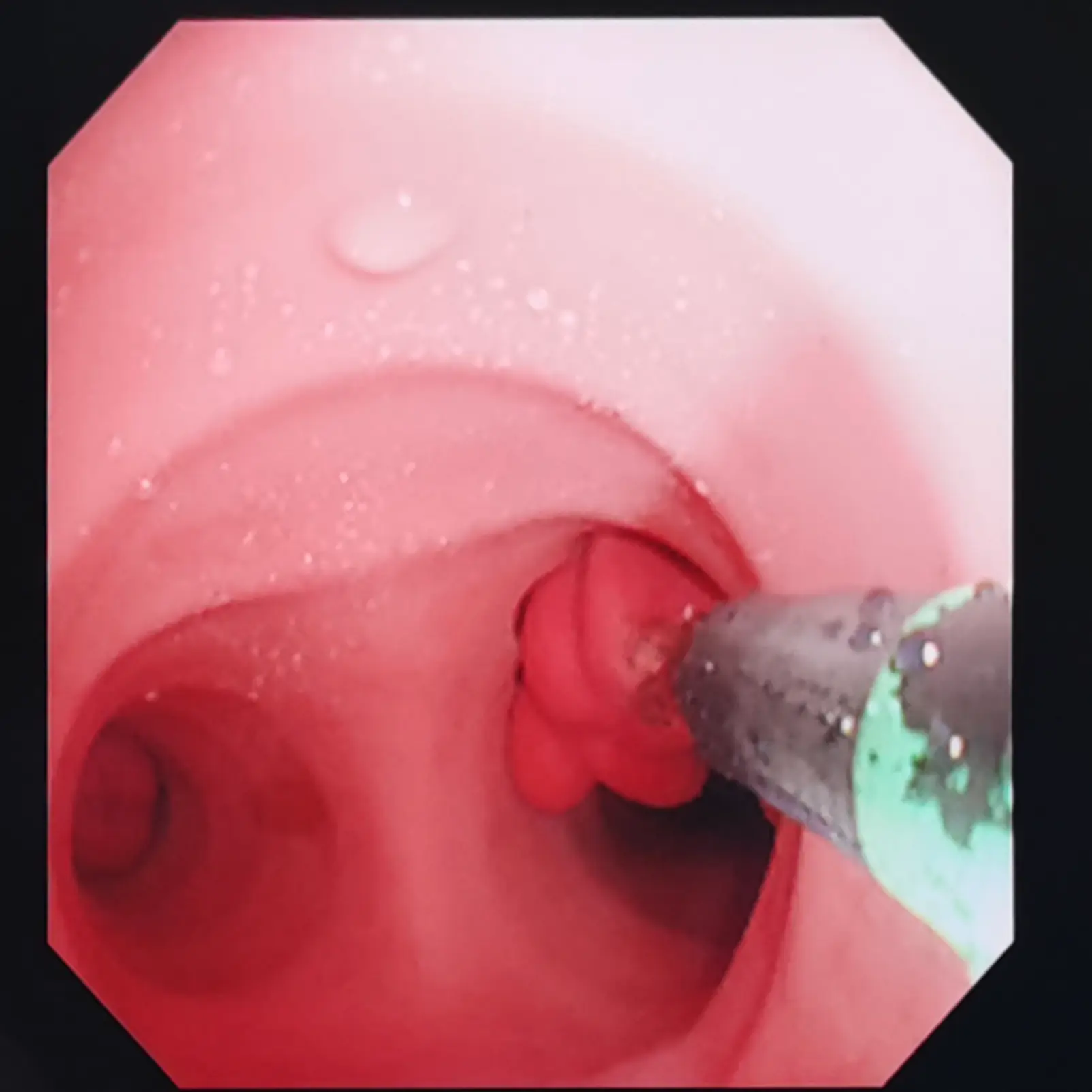 Endobronchial Therapy Training Model
