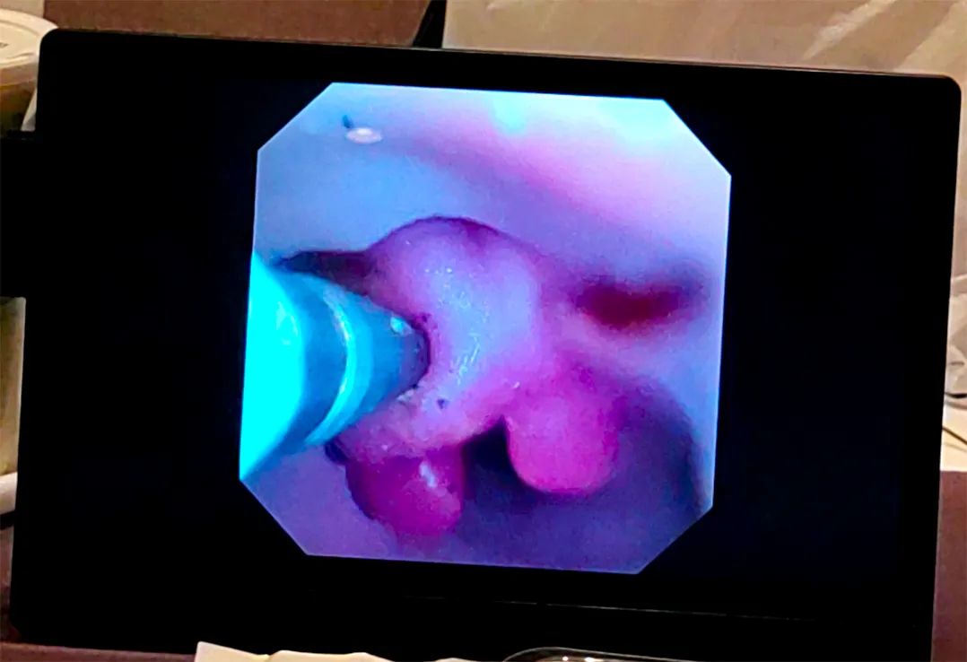 electroresection gel lesion module supplier